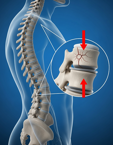 Vertebral Compression Fracture - Abovepain
